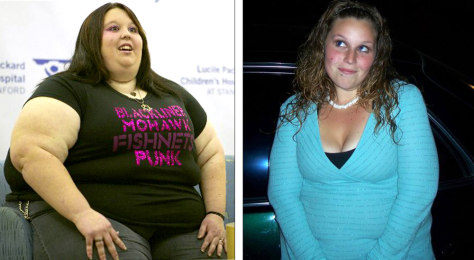 before and after weight loss surgery pictures