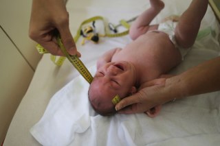 Image: Baby with microcephaly in Brazil