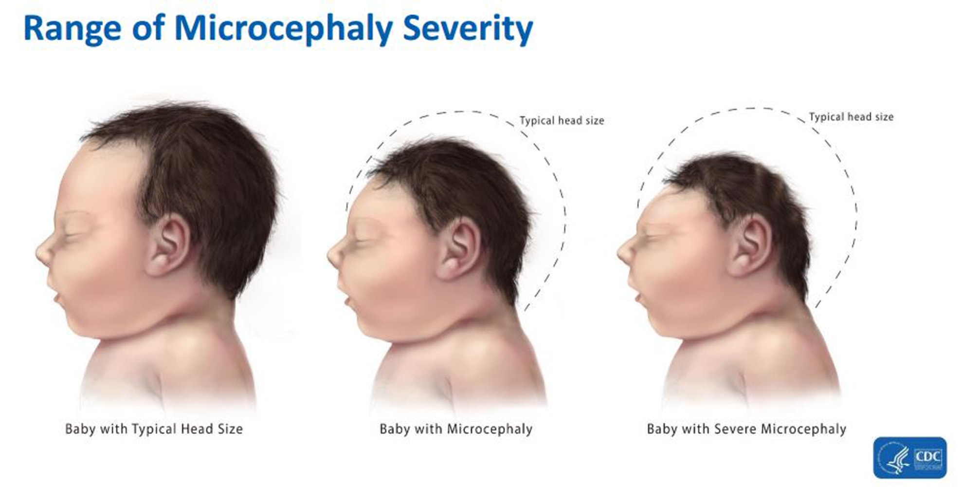 Image result for cdc microcephaly
