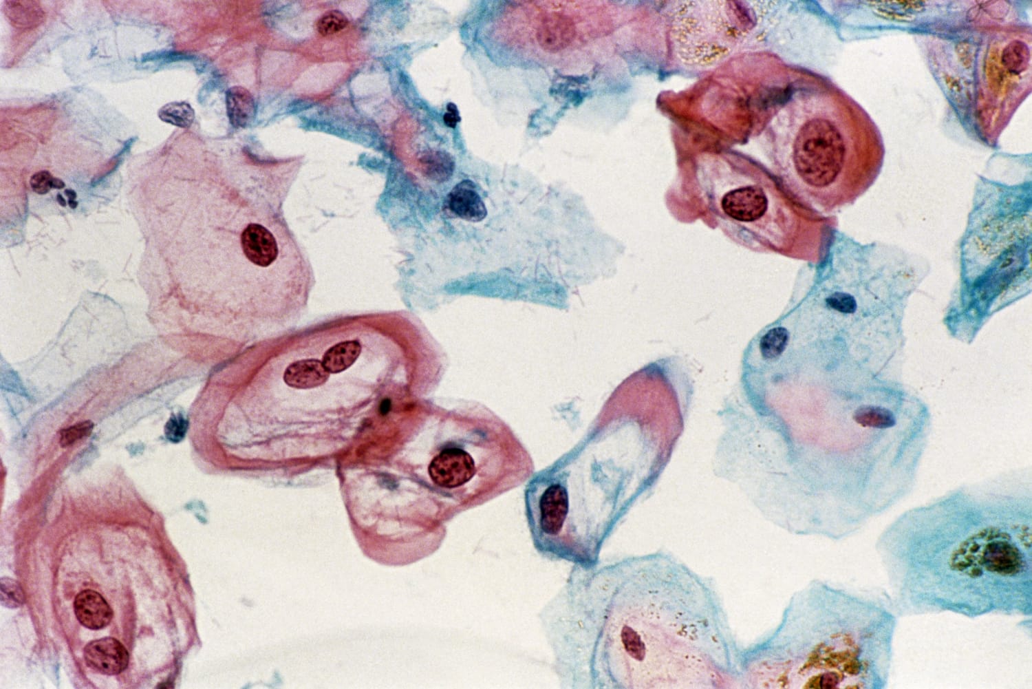 Human Papilloma Vírus – a HPV — Dr. Fekete István, Hpv vírus és pap 1