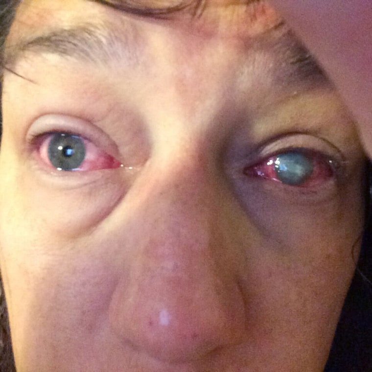 Stacey Peoples, who almost lost her vision to a parasite after swimming in contact lenses.
