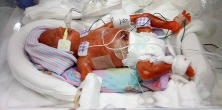 Le gemelle Everlei e Rylei sono nate a 22 settimane e 2 giorni.